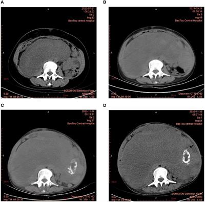 Recurrent retroperitoneal liposarcoma with multiple surgeries: a case report